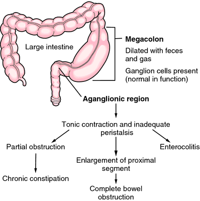 aganglionic