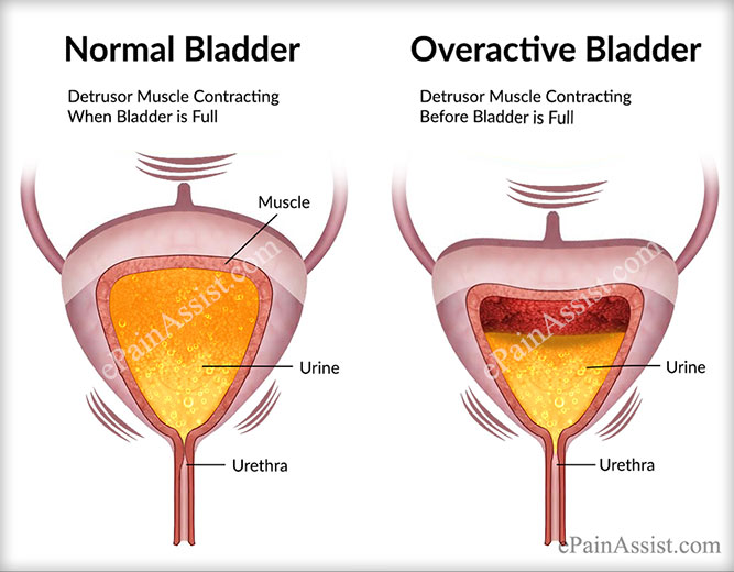 nervous bladder