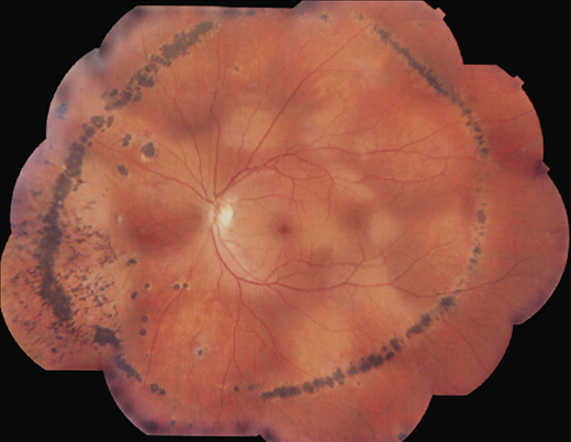 sclerochoroiditis