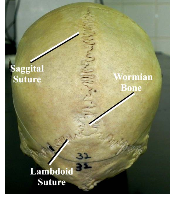 wormian