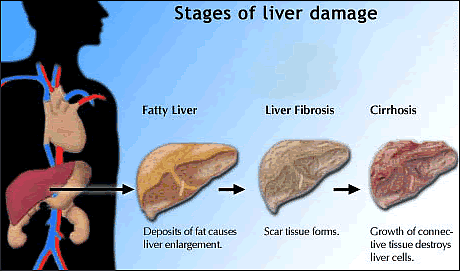 chronic active liver disease